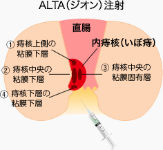 ALTA（ジオン）注射